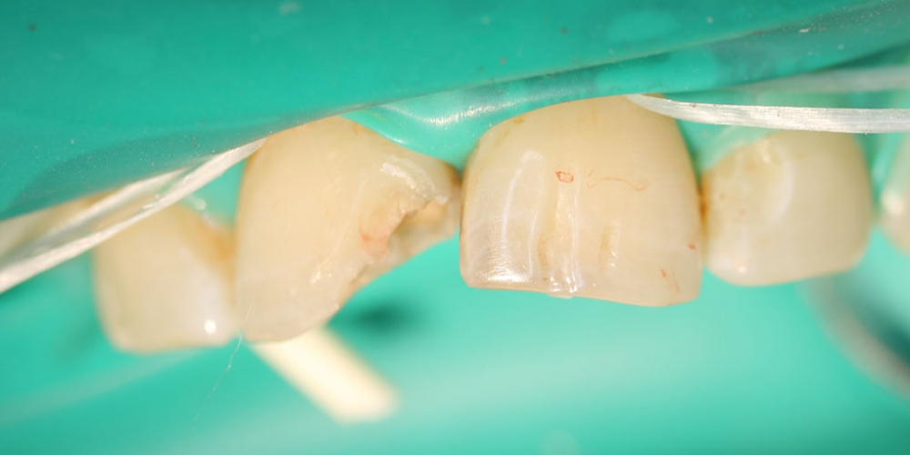  Результат лечение глубокого кариеса двух передних зубов за один прием