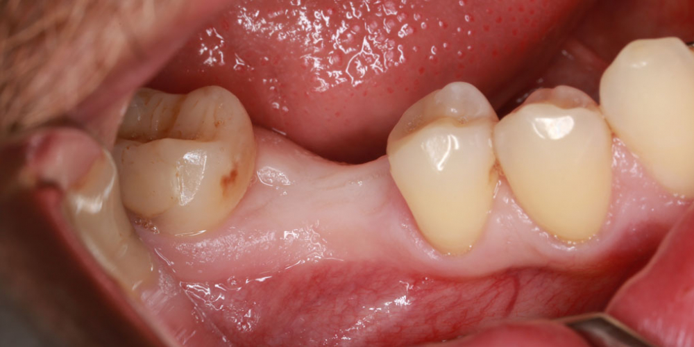  Восстановление жевательного зуба имплантатом Osstem + коронка