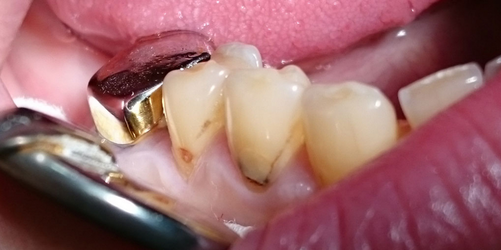  Лечение клиновидного дефекта, восстановление анатомической формы зуба