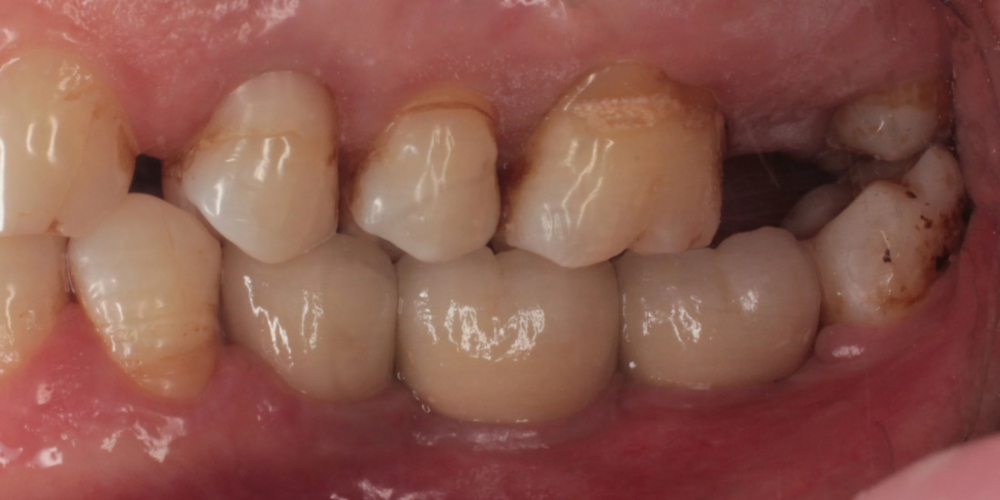  Имплантация трех зубов подряд, м/к коронки