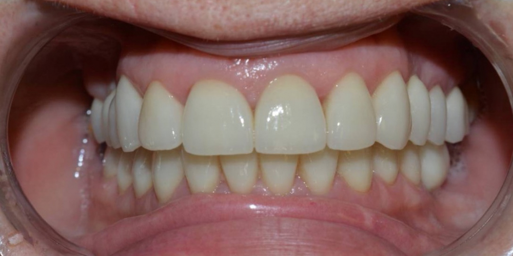  Установка 4 имплантатов для восстановления отсутствующих зубов