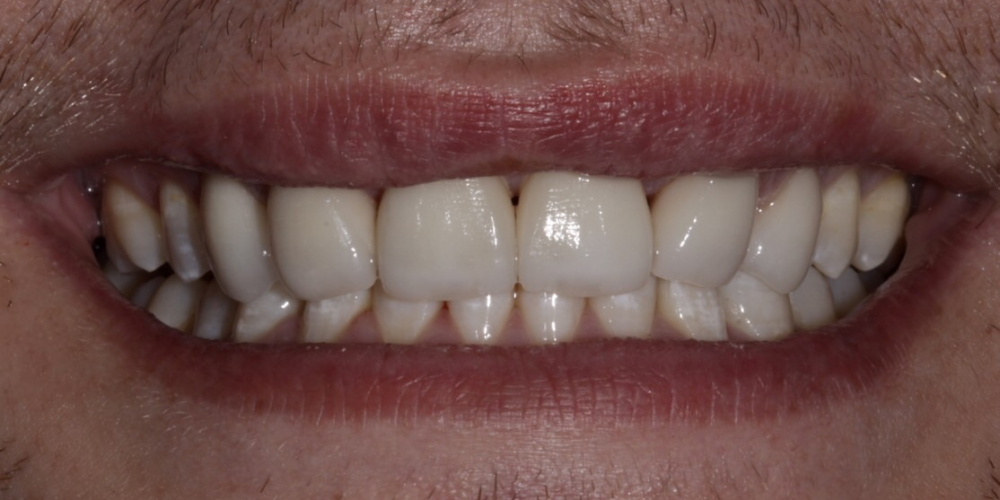  Изменение формы зубов верхней челюсти, коррекция цвета, восстановление функции