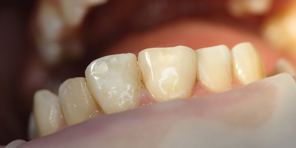  Результат лечения среднего кариеса зуба 1.1