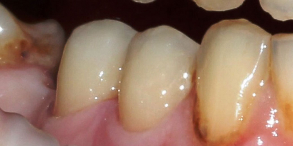  Результат лечения пришеечного кариеса зубов