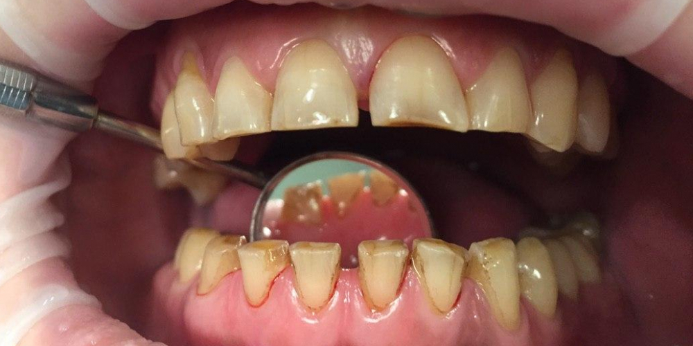  Профессиональная гигиена полости рта, результат до и после чистки