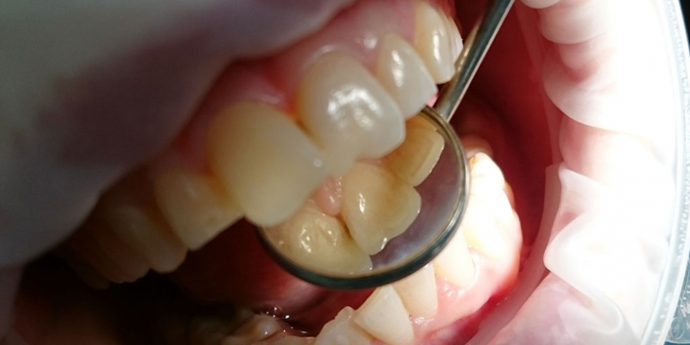  Жалоба на эстетическое несовершенство 2.1 зуба и потемнение между 1.1 и 2.1 зубами