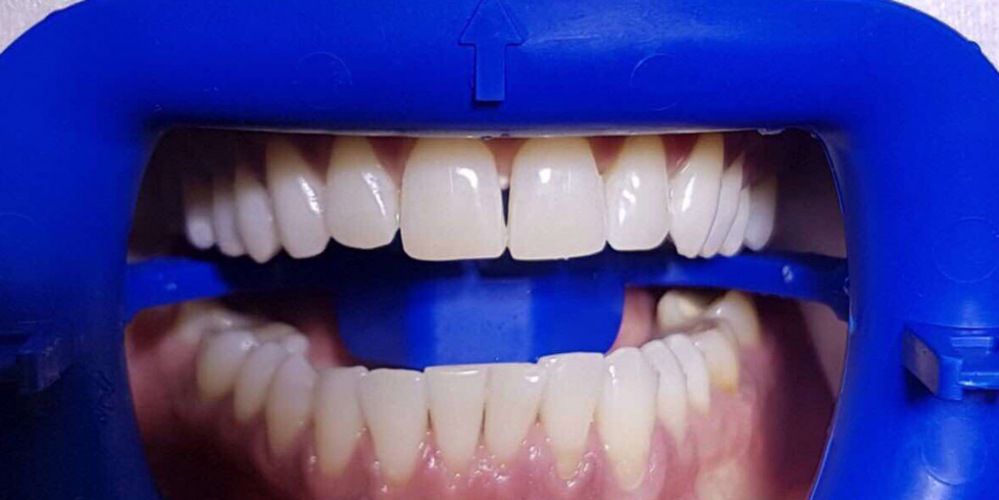  Результат отбеливания зубов ZOOM-3