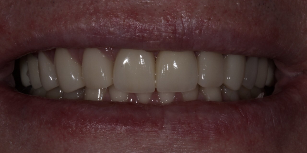  Установка 2 иплантантов Straumann и восстановление формы, функции и эстетики зубов винирами
