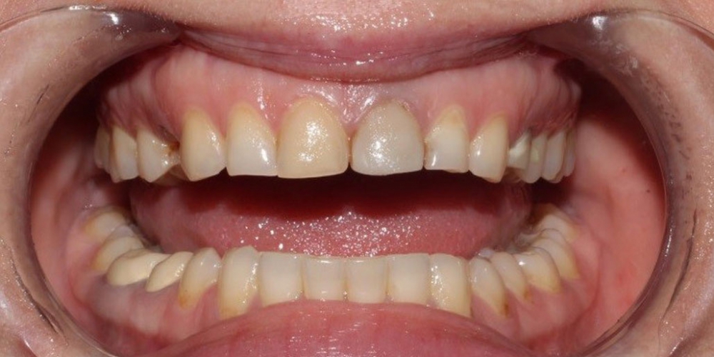  Протезирование центральных зубов верхней челюсти керамическими винирами