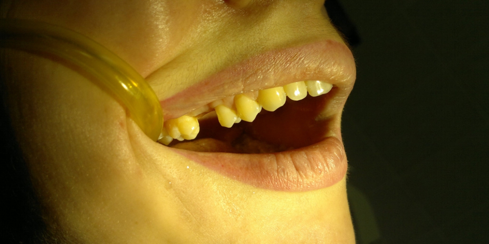  Установка имплантата в область отсутствующего зуба