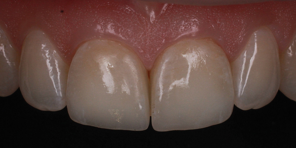  Цельнокерамические виниры E-max на передние зубы