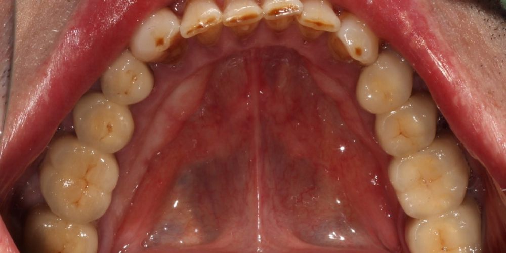  Протезирование жевательных зубов металлокерамическими коронками