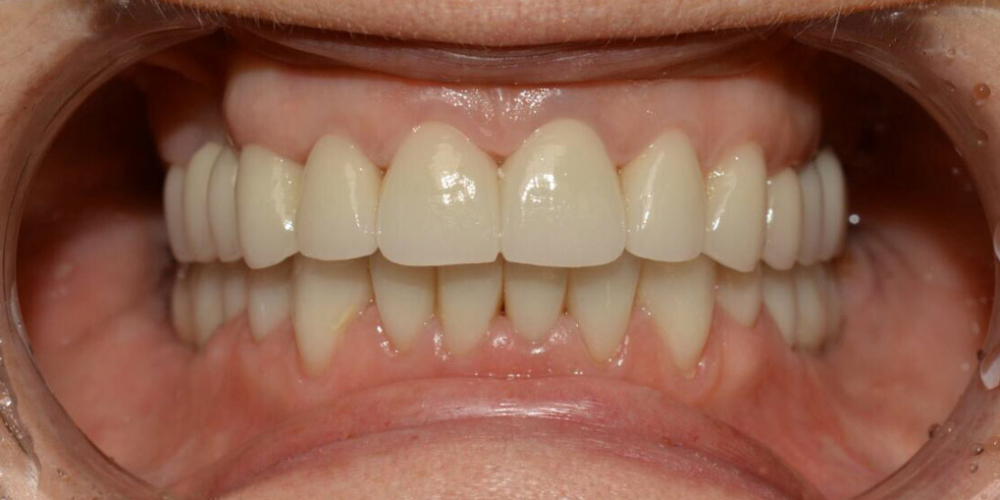  Восстановление зубов с использованием коронок на основе диоксида циркония и керамических виниров