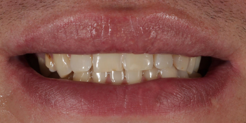  Восстановление зубов верхней и нижней челюсти керамическими винирами E.max