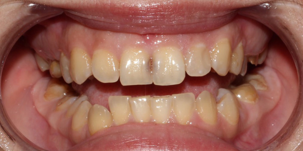 Устранение тёмных пятен между передними верхними зубами