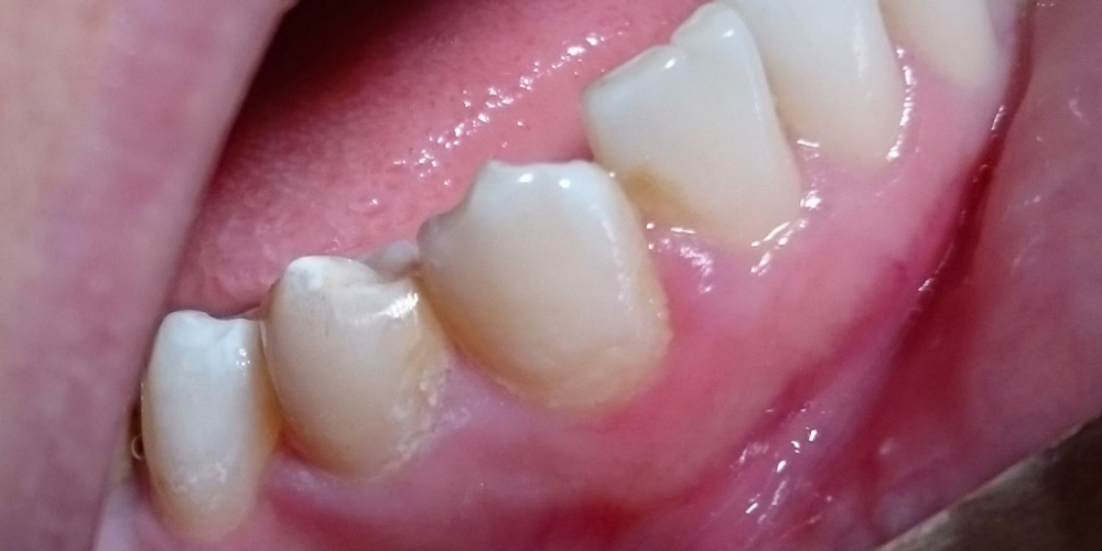 Лечение кариеса зуба 4.4, материал Estelite