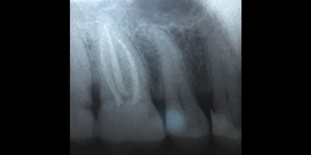  Хронический фиброзный пульпит 16 зуба