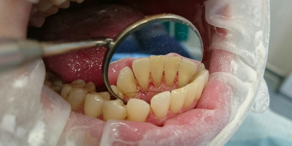  Жалобы на кровоточивость десен при чистке зубов и наличие зубных отложений