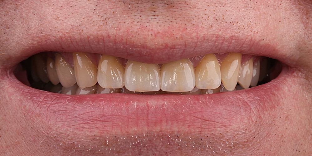  Цельнокерамические виниры на передние зубы без депульпирования зубов