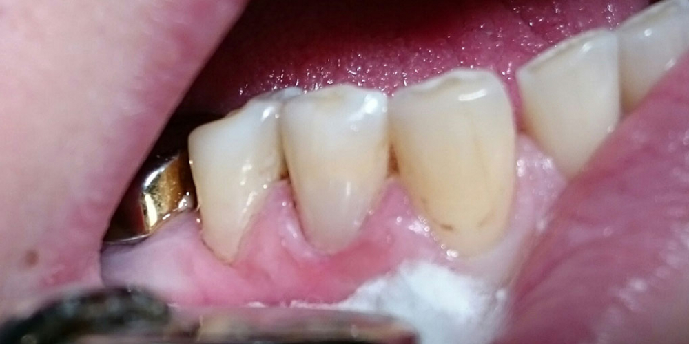  Лечение клиновидного дефекта, восстановление анатомической формы зуба