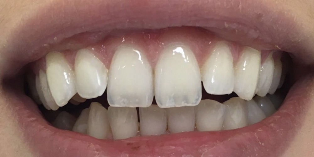 Результат отбеливания зубов с помощью системы Zoom 3