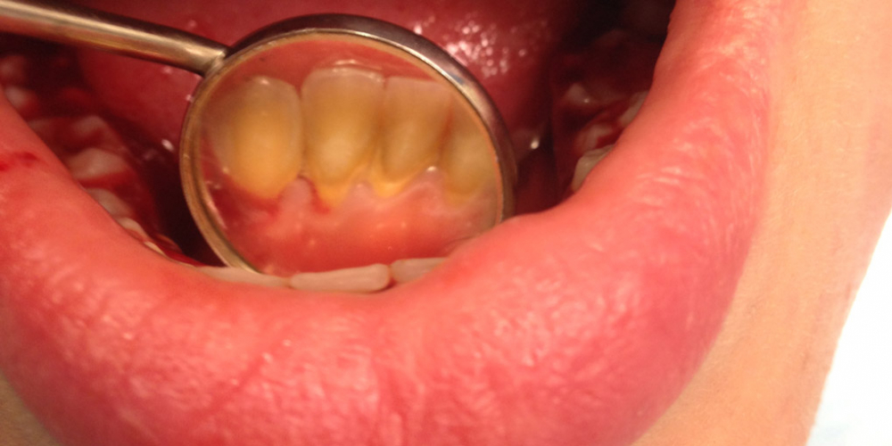  Жалобы на наличие зубных отложений и кровоточивость десен