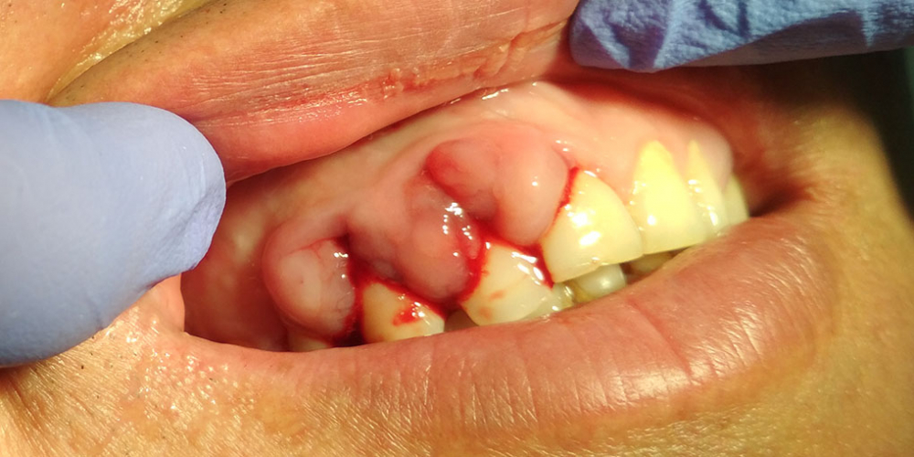  Результат лечения отека десны, кровоточивость при чистке зубов