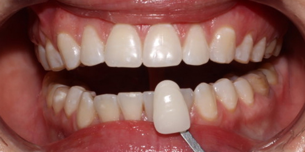  Фото результата отбеливание зубов с помощью системы Zoom 3