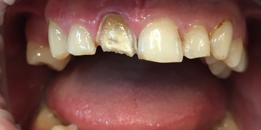  Восстановление зубов керамической вкладкой и керамическим виниром