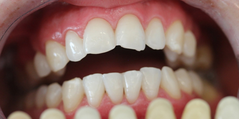  Результат отбеливания зубов системой ZOOM при дисколорите
