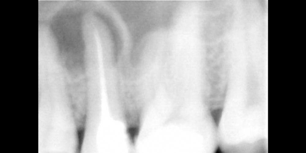  Перелечивание корня зуба