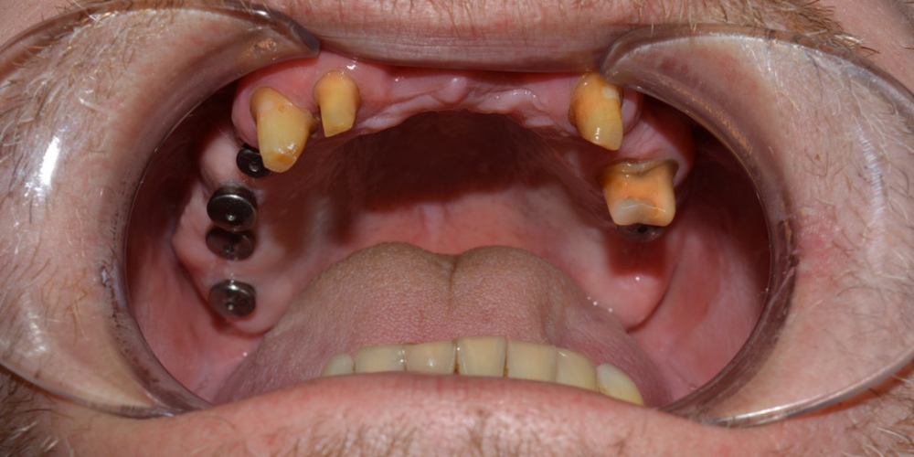  Восстановление зубов ВЧ с использованием имплантатов и мостовидных протезов на своих зубах