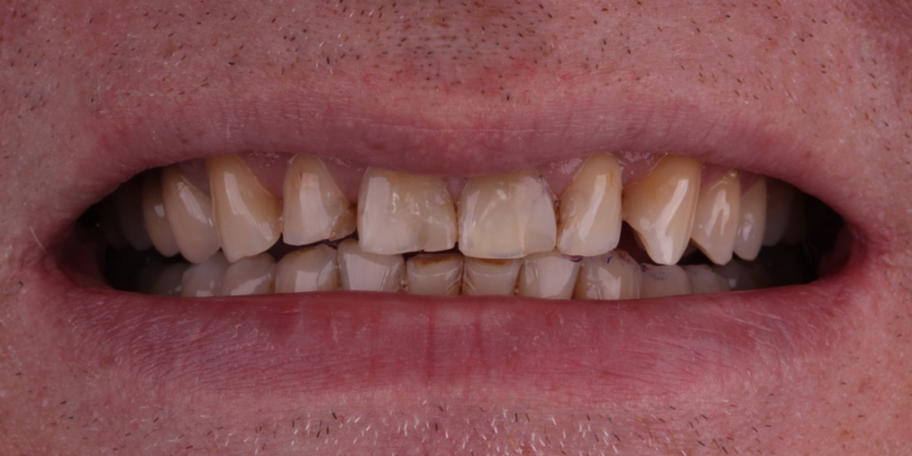  Цельнокерамические виниры на передние зубы без депульпирования зубов