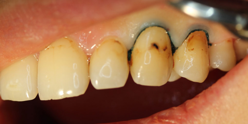  Результат лечения среднего кариеса двух зубов за один прием