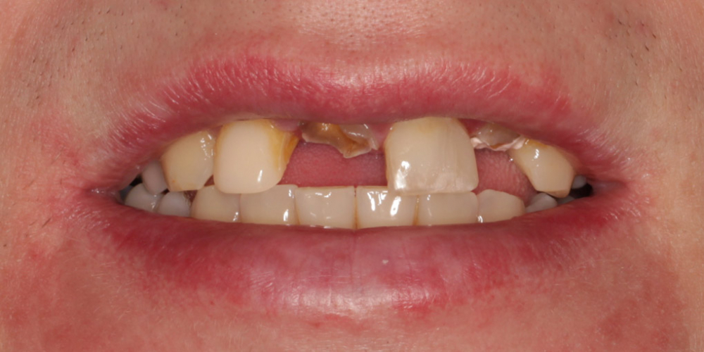  Восстановление центральных зубов верхней челюсти коронками на основе диоксида циркония
