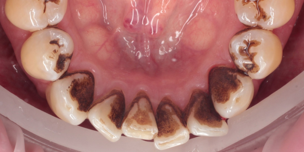  Снятие твердых зубных отложений (зубного камня) ультразвуком