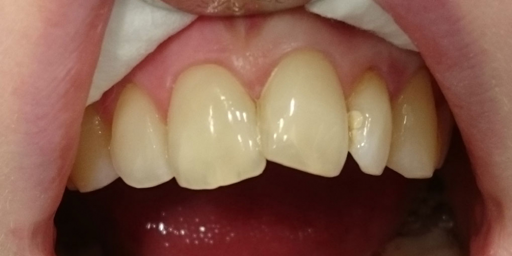  Восстановление анатомической формы 2.1 зуба материалом Estelite