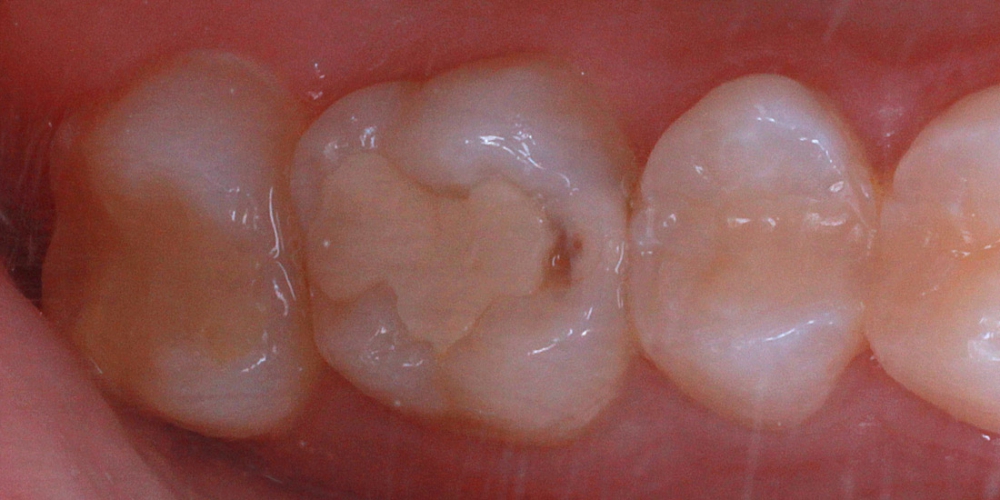  Замена пломбы и эстетическая реставрация жевательного зуба