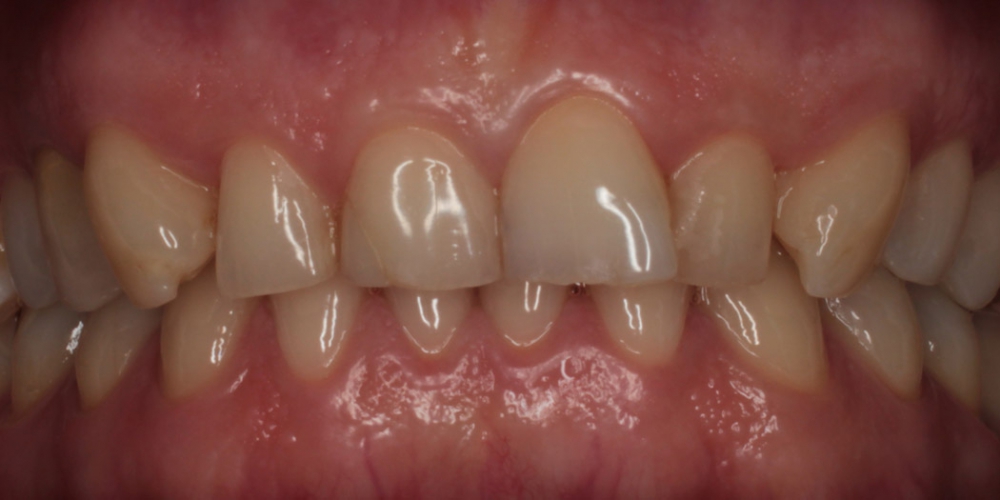  Удлинение коронковой части передних зубов