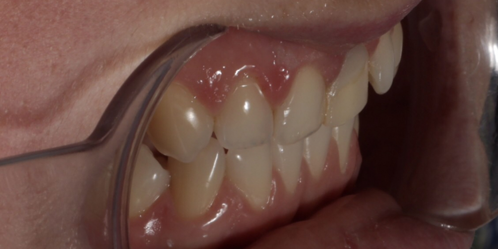 Эстетическое преобразование передних зубов верхней челюсти