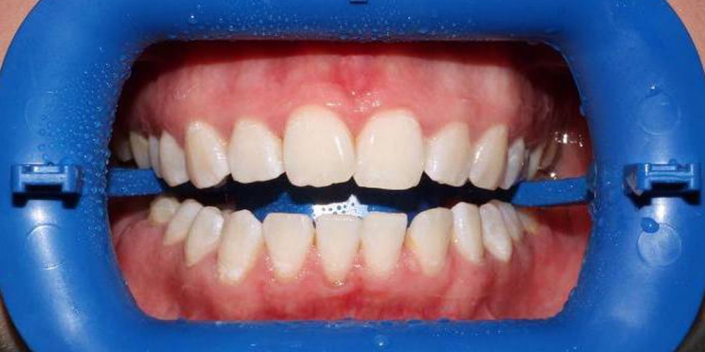  Результат отбеливания зубов с использованием системы Zoom-3