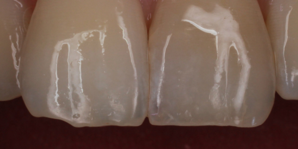 Оперативное устранения скола центрального зуба