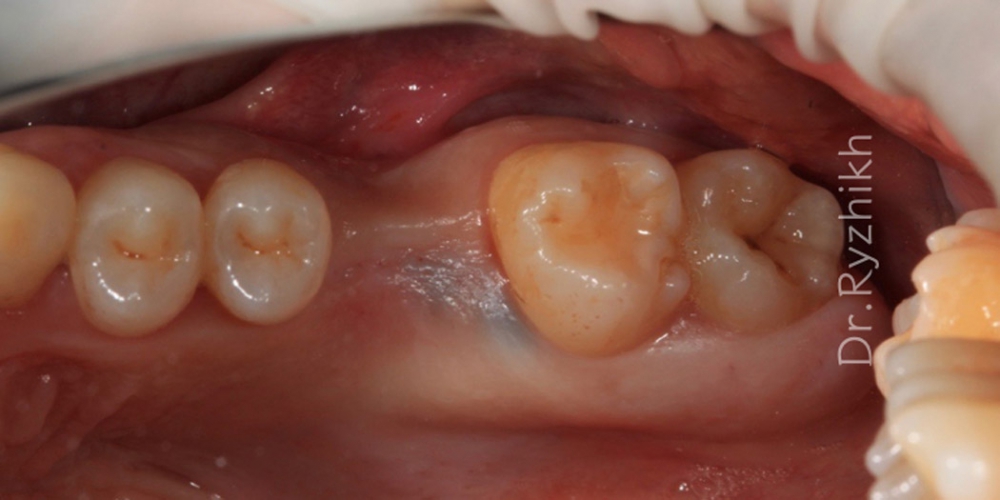 Фото до имплантации имплантата. Установка имплантата Dentium + синус-лифтинг