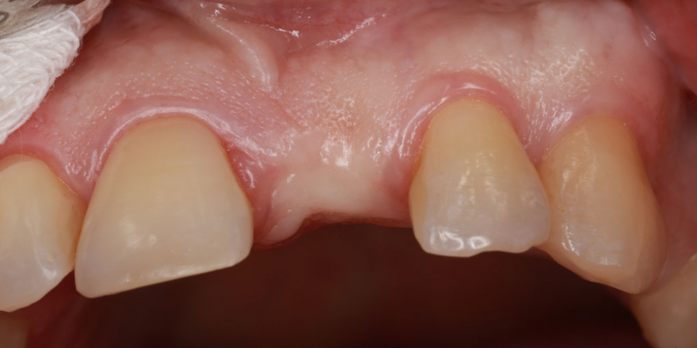  Восстановление зуба с помощью вживления имплантата и коронки
