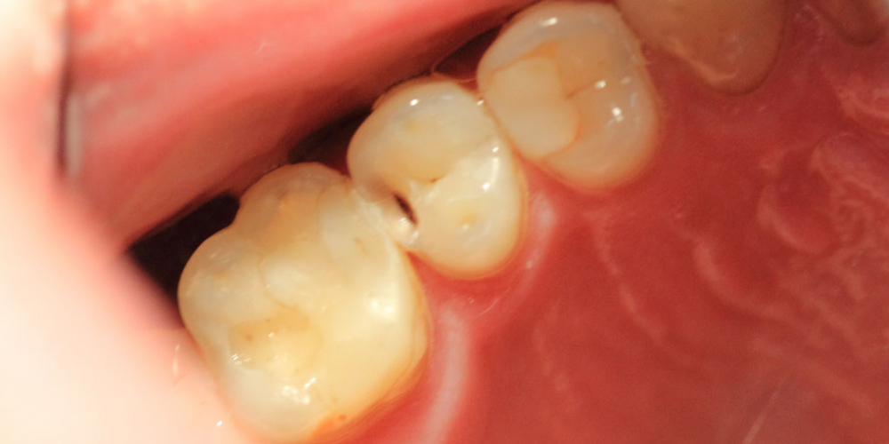  Результат лечения глубокого кариеса зуба 1.5