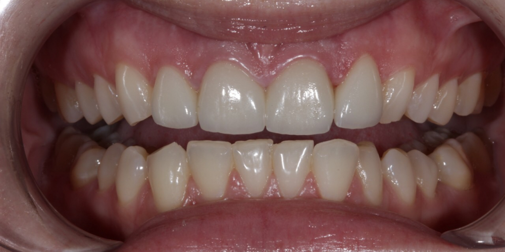  Восстановление резцов верхней челюсти керамическими винирами E.max и отбеливание Zoom3