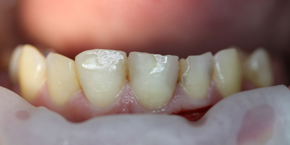  Результат лечения среднего кариеса зуба 1.1