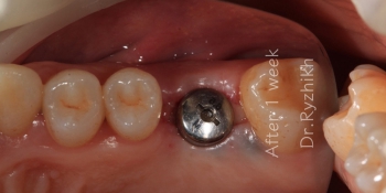 Установка имплантата Dentium + синус-лифтинг фото после лечения