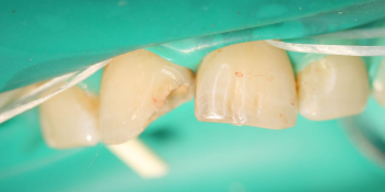 Результат лечение глубокого кариеса двух передних зубов за один прием фото до лечения