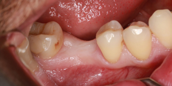 Восстановление жевательного зуба имплантатом Osstem + коронка фото до лечения